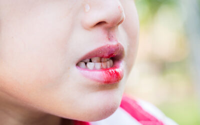 Zahnunfall? 10 Tipps für die Zahnrettung
